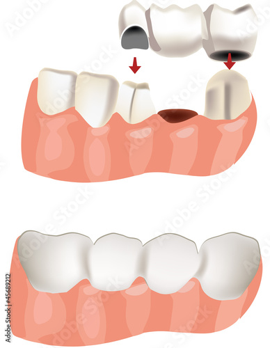 ponte dentale prima e dopo-dental bridge before and after