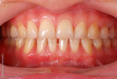 human teeth photo