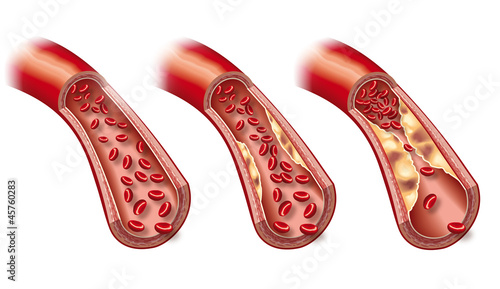 Arteriosclerosis, medically accurate 3D illustration showing healthy blood vessel and beginning  of arteriosclerosis