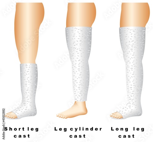 Leg casts are used for thigh, knee, or lower leg fractures