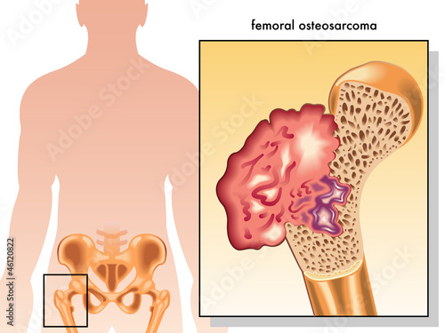 osteosarcoma femorale