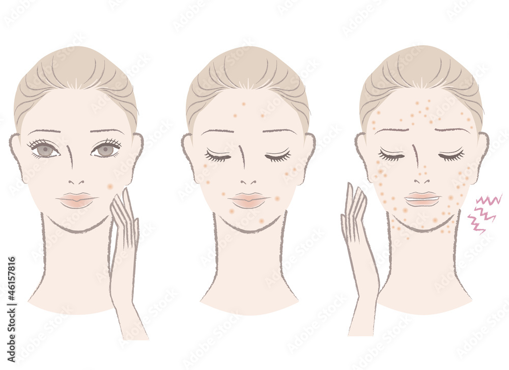 ニキビ 肌トラブル 悩み 女性 イラスト Stock Illustration Adobe Stock