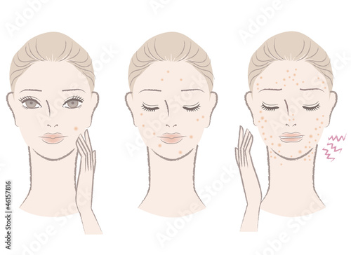 ニキビ 肌トラブル 悩み 女性 イラスト Stock Illustration Adobe Stock ニキビ 肌トラブル 悩み 女性 イラスト Stock Illustration Adobe Stock