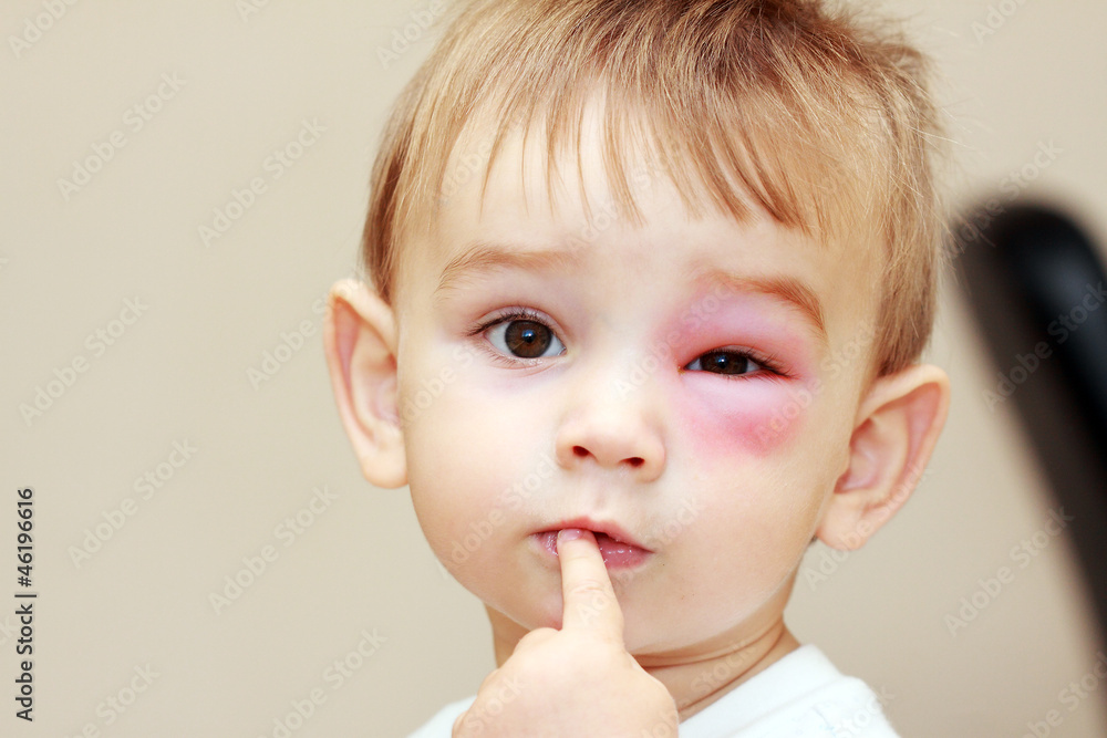 little boy - dangerous stings from wasps near the eye little boy - dangerous stings from wasps near the eye