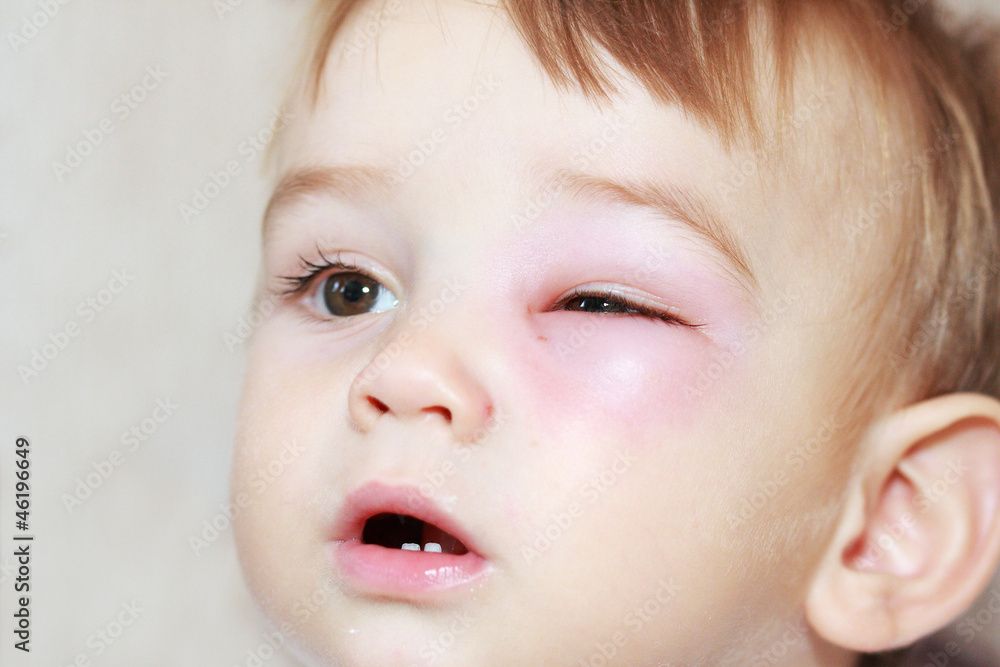 little boy - dangerous stings from wasps near the eye little boy - dangerous stings from wasps near the eye