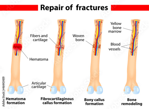 Fracture and repair. Vector scheme.