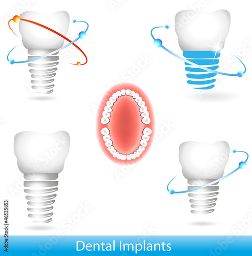 Dental implants