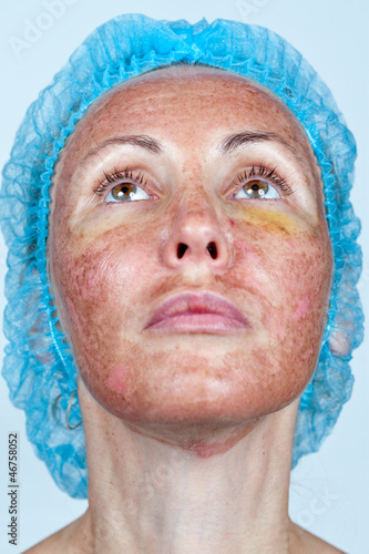 Chemical peeling.Boundary between processed and healthy skin photo