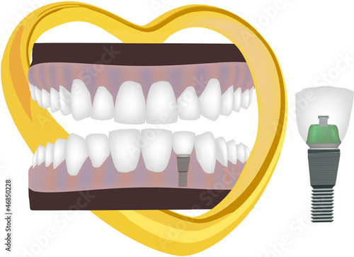 protesi dentale -	dental prosthesis