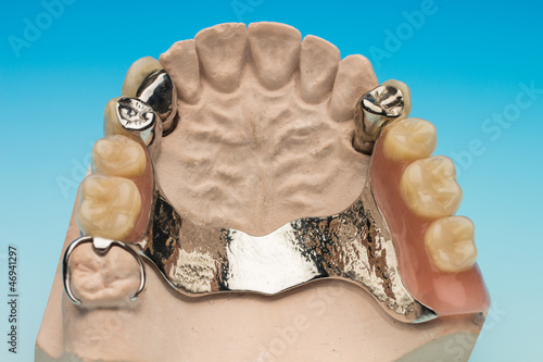 Gebiss Zahnersatz von oben Abdruck