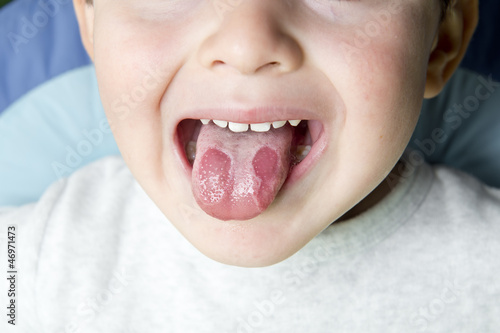 Niño con lengua geográfica mostrando los síntomas