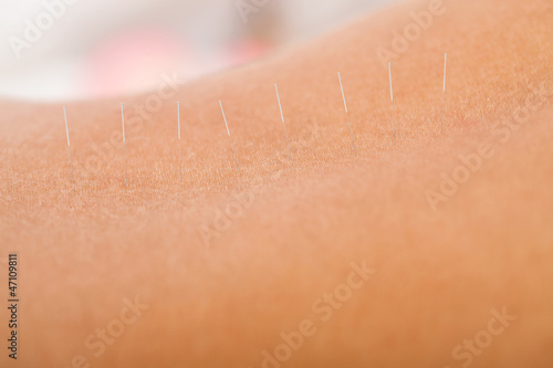Acupuncture needle inserted