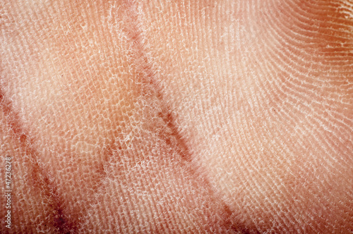 human dried skin