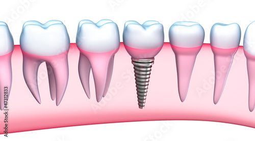 Dental Implant detailed view. 3D Illustration