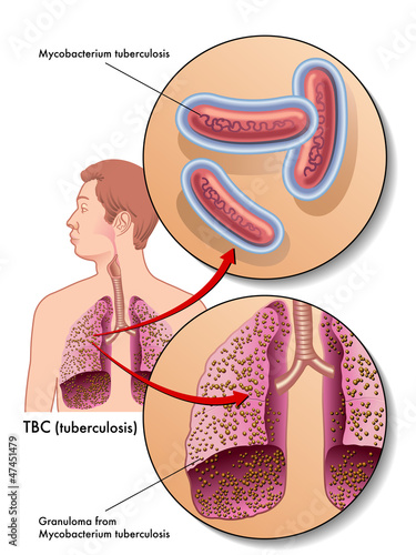 tubercolosi