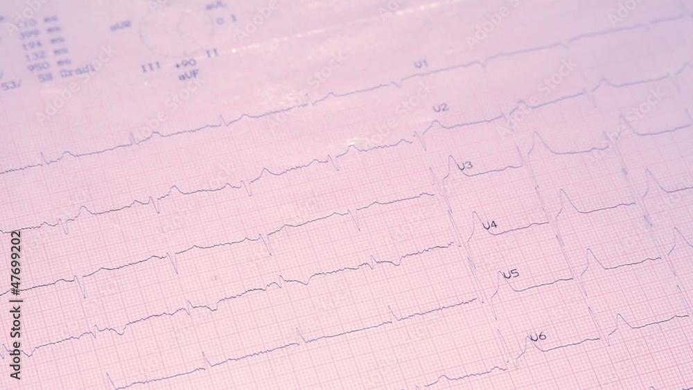 electrocardiogram and stethoscope electrocardiogram and stethoscope