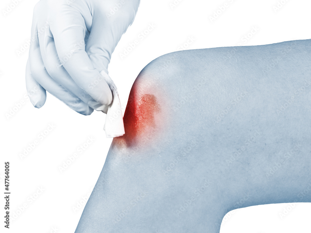 Fototapeta premium Hand disinfecting wound on hand knee.