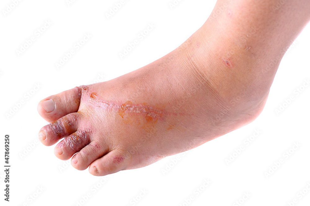 Fototapeta premium Wounds on women foot