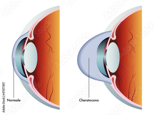 cheratocono photo