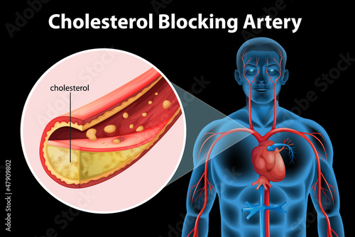 Ateriosclerosis