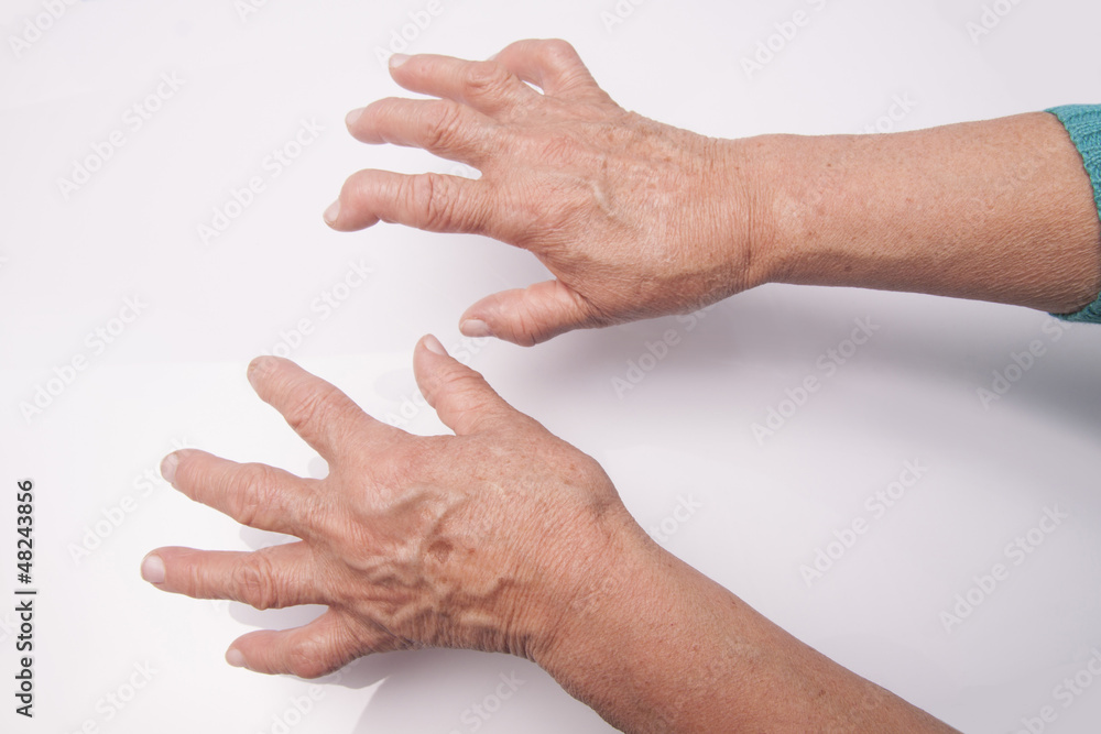 Hands With Rheumatoid Arthritis Hands With Rheumatoid Arthritis