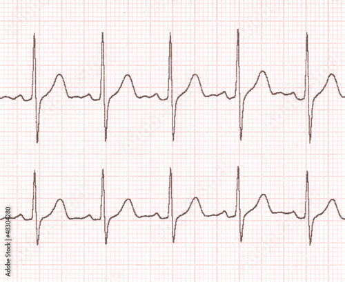 Schilderij op canvas cardiogram