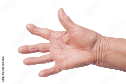 Hand With Rheumatoid Arthritis