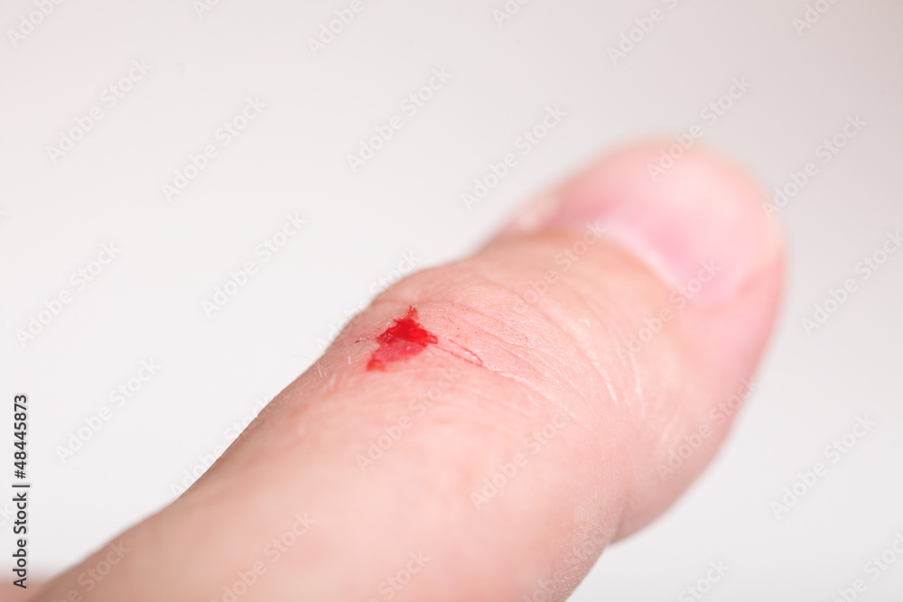 Fototapeta premium disinfect the scratch alcohol cuts hand health