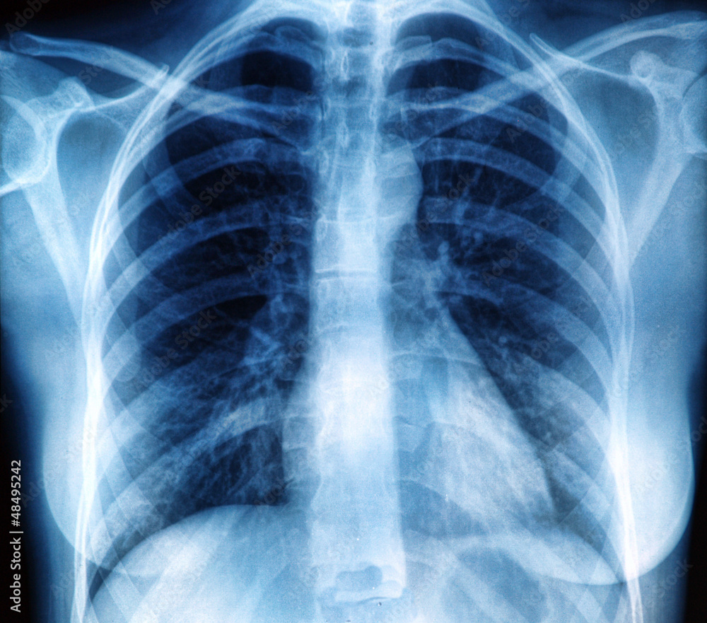Chest X-ray image Stock Photo | Adobe Stock