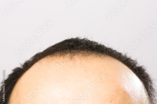 getting bald