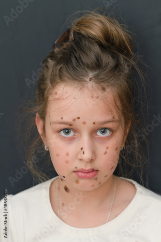 Obraz na plátně chickenpox varicella zoster virus
