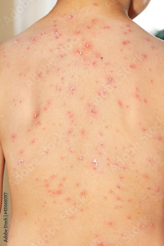 Baby boy with chicken pox rash