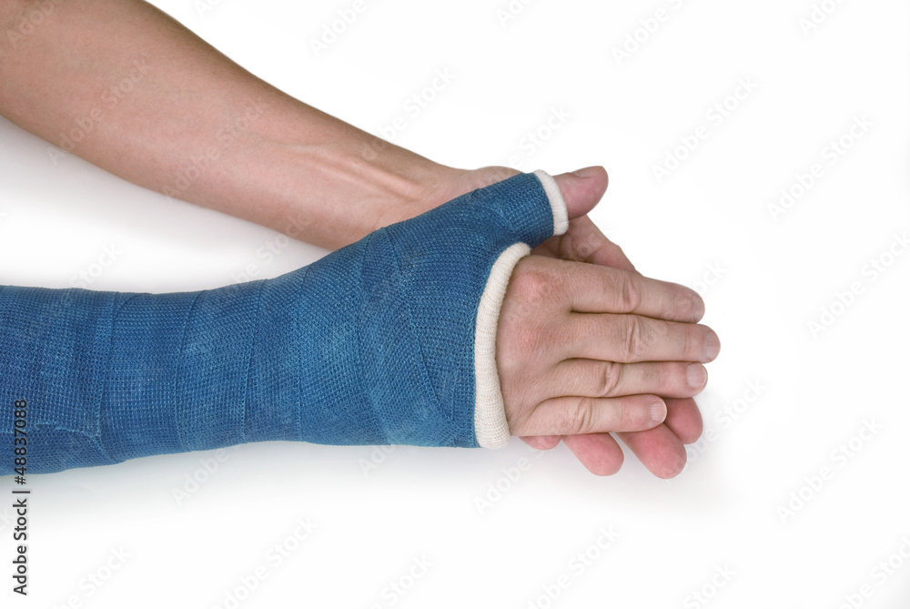 And Blue Wrist Fingers Cast