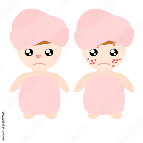 Acne is enemy of woman