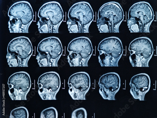 MRI Brain Scan photo