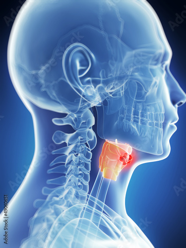 Schilderij op canvas 3d rendered illustration of the male larynx - cancer