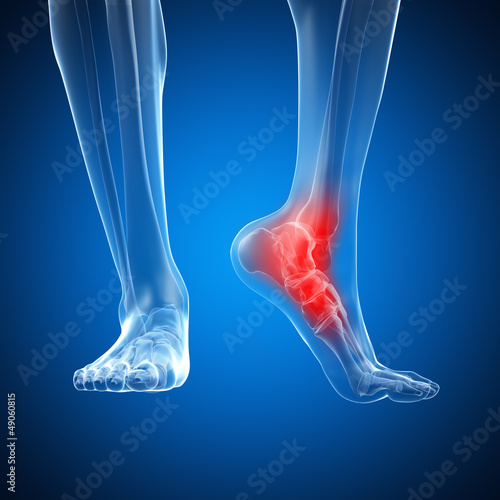 3d rendered illustration of a painful ankle