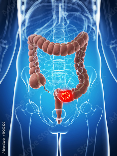 3d rendered illustration of the male colon - cancer. photo