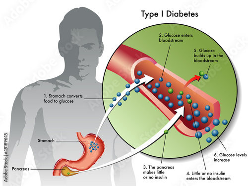 Diabete tipo 1