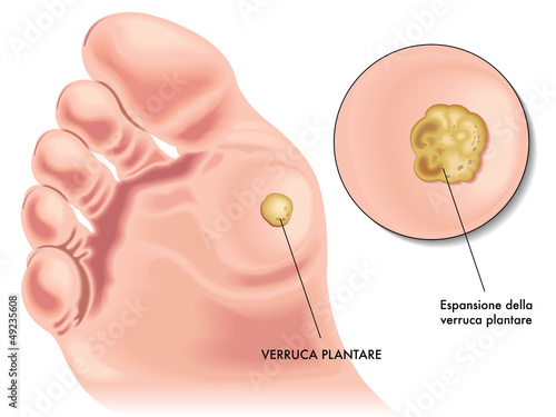 verruca plantare photo