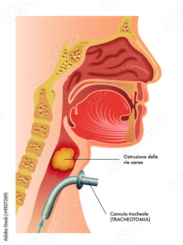 tracheotomia