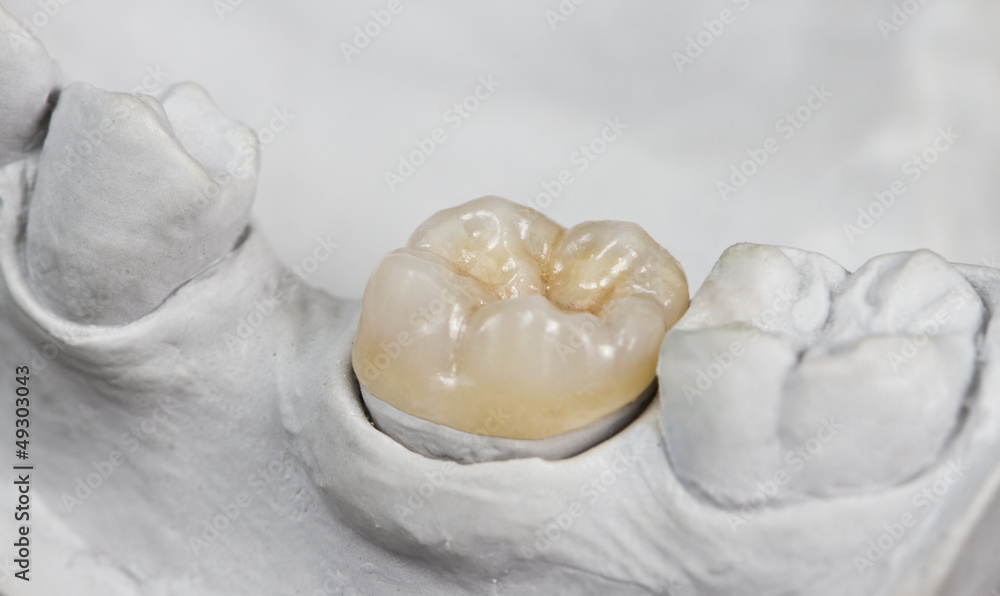 Fotografie dental onlay on a cast model
