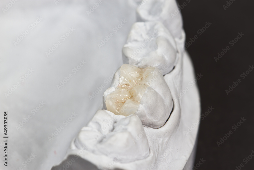 Φωτογραφία dental onlay on a cast model