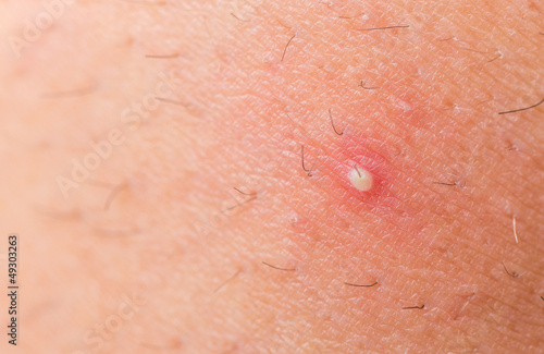 Foto ingrown hair closeup