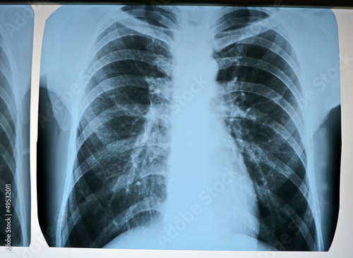 pneumonia test scanning, monkeypox corona virus covid19 infection, modern x-rays radiography closeup diversity photo