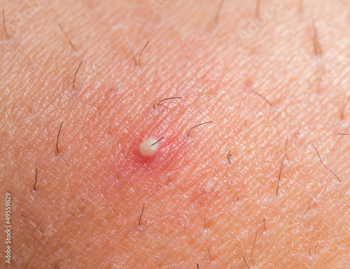 Quadro su tela ingrown hair