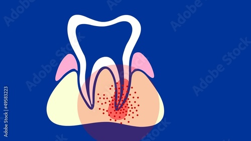 Zahnwurzelentzündung