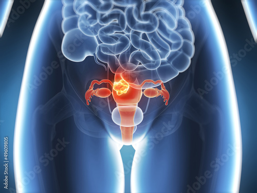 Fényképezés 3d rendered illustration - uterus cancer