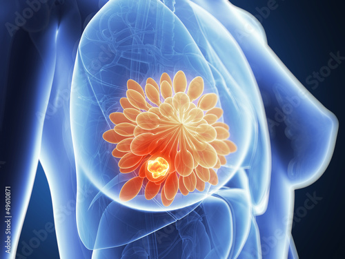 Obraz na plátne 3d rendered illustration - breast cancer