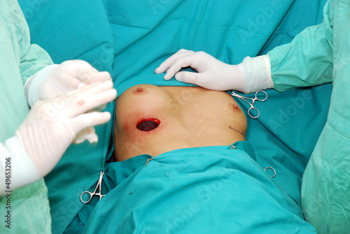 Fototapeta Breast augmentation, surgeon cutting the breast.